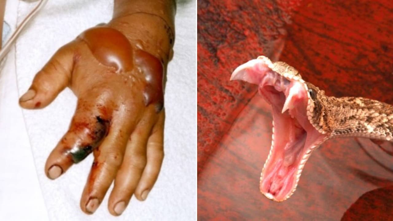 ¿Qué hacer en caso de recibir una mordedura de serpiente? El tiempo es crucial