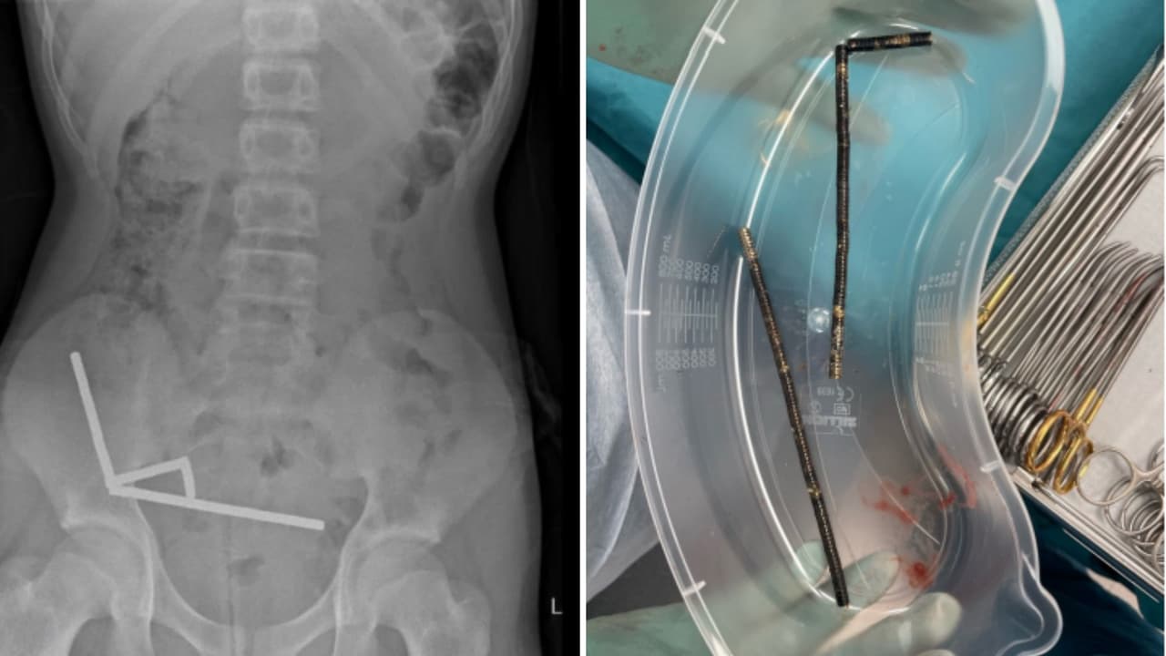 El menor que perdió parte de su intestino tras ingerir casi 100 imanes comprados en Temu 