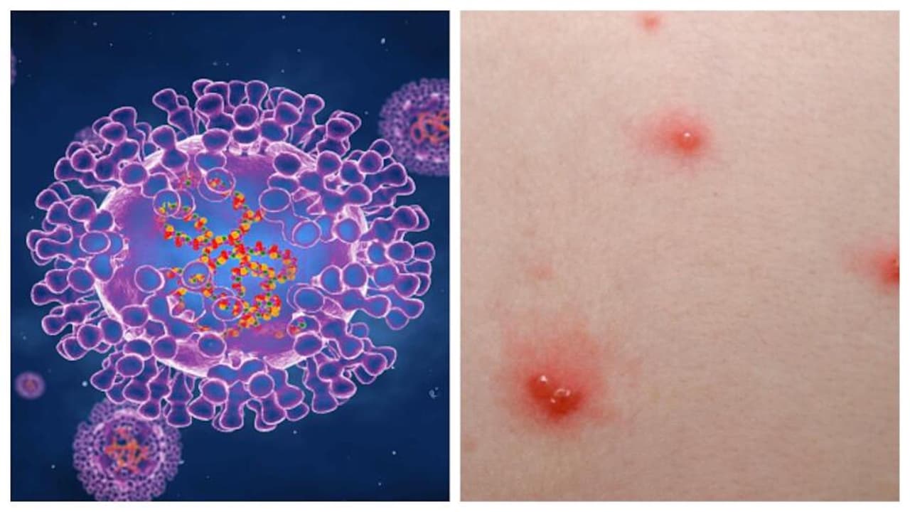 <b>¿La viruela del mono es mortal?</b>
<br>
<br>No, el médico aclara que el virus no amenaza la vida de las personas infectadas. Las lesiones o ronchas pueden durar en la piel de los contagiados por un mes y es probable que el dolor, picazón o ardor que ocasionan sean tan intensas que amerite hospitalizaciones en algunos casos.
<br>