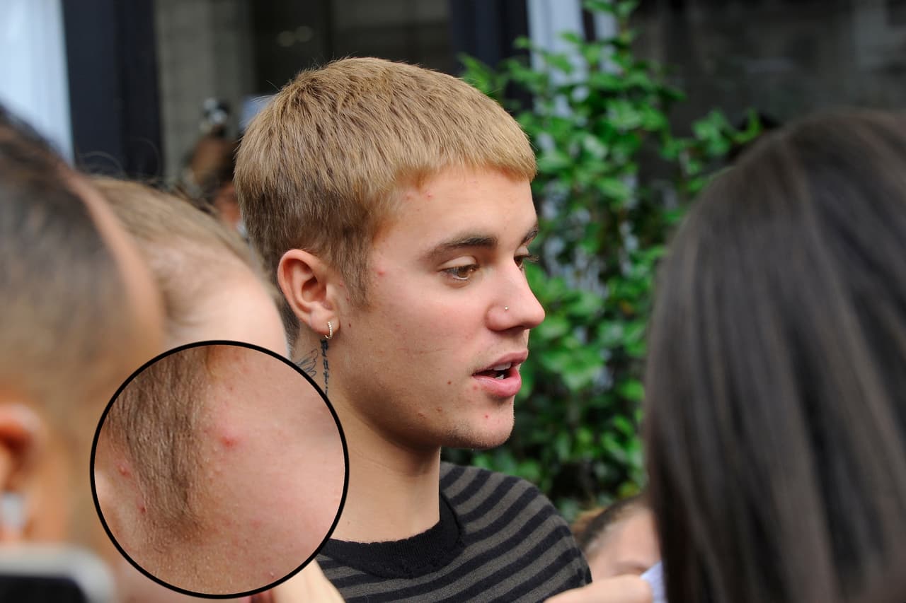 Justin tiene acné como millones de personas en el mundo.