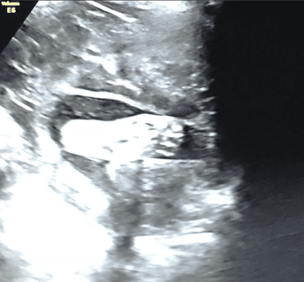 Y este es el más reciente ultrasonido de 'babymoon', en el cual solo se dejó ver su piecito. Se prevé que la bebé nacerá en las primeras semanas de junio próximo.