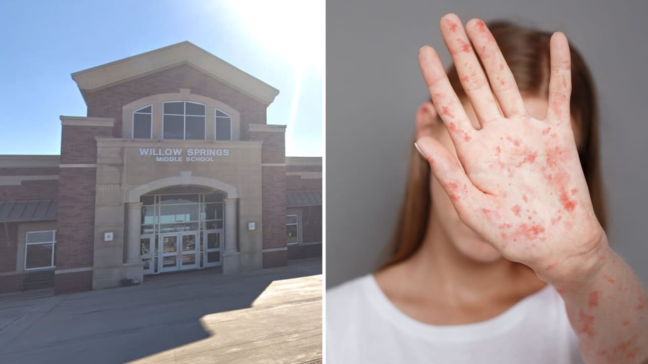 Sarampión en el norte de Texas: confirman caso en un estudiante de una secundaria en el condado Collin