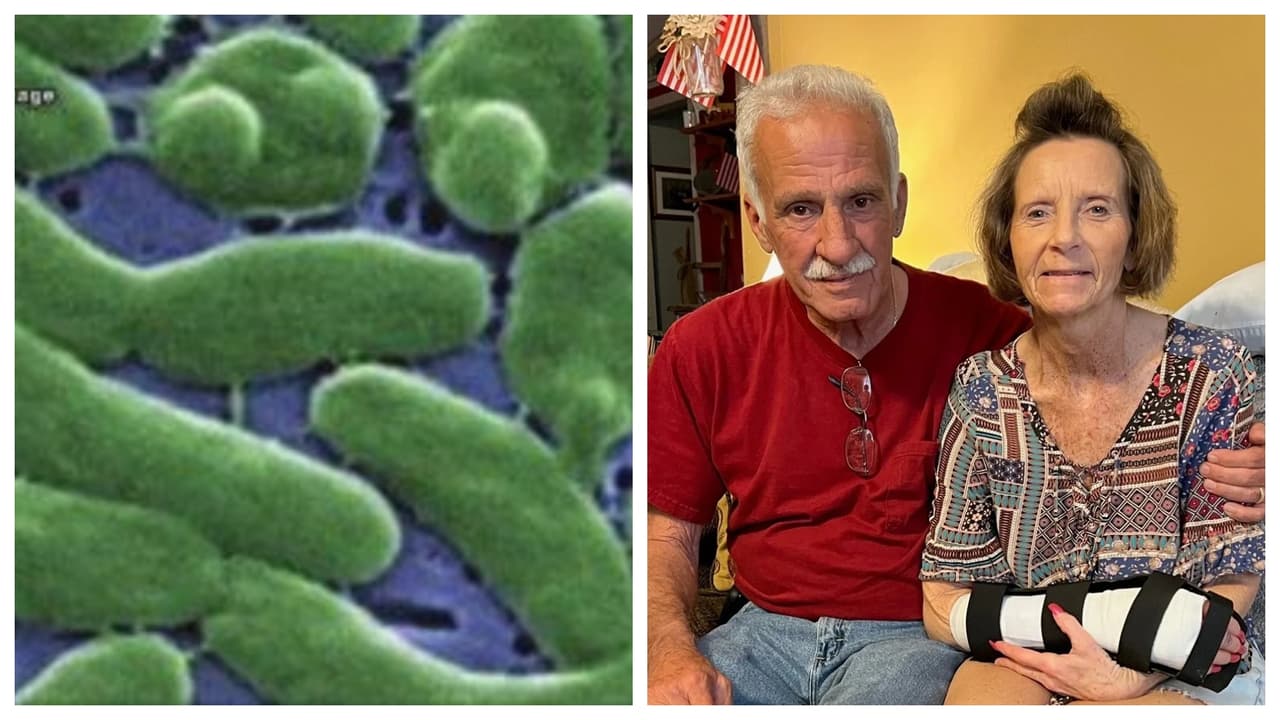 Mujer estuvo a punto de morir por bacteria "carnívora": le amputaron dedo pulgar de su mano 