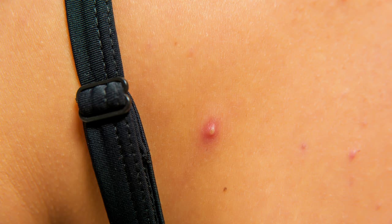 Una protuberancia en la piel con un punto blanco NO necesariamente es acné: 5 causas ocultas