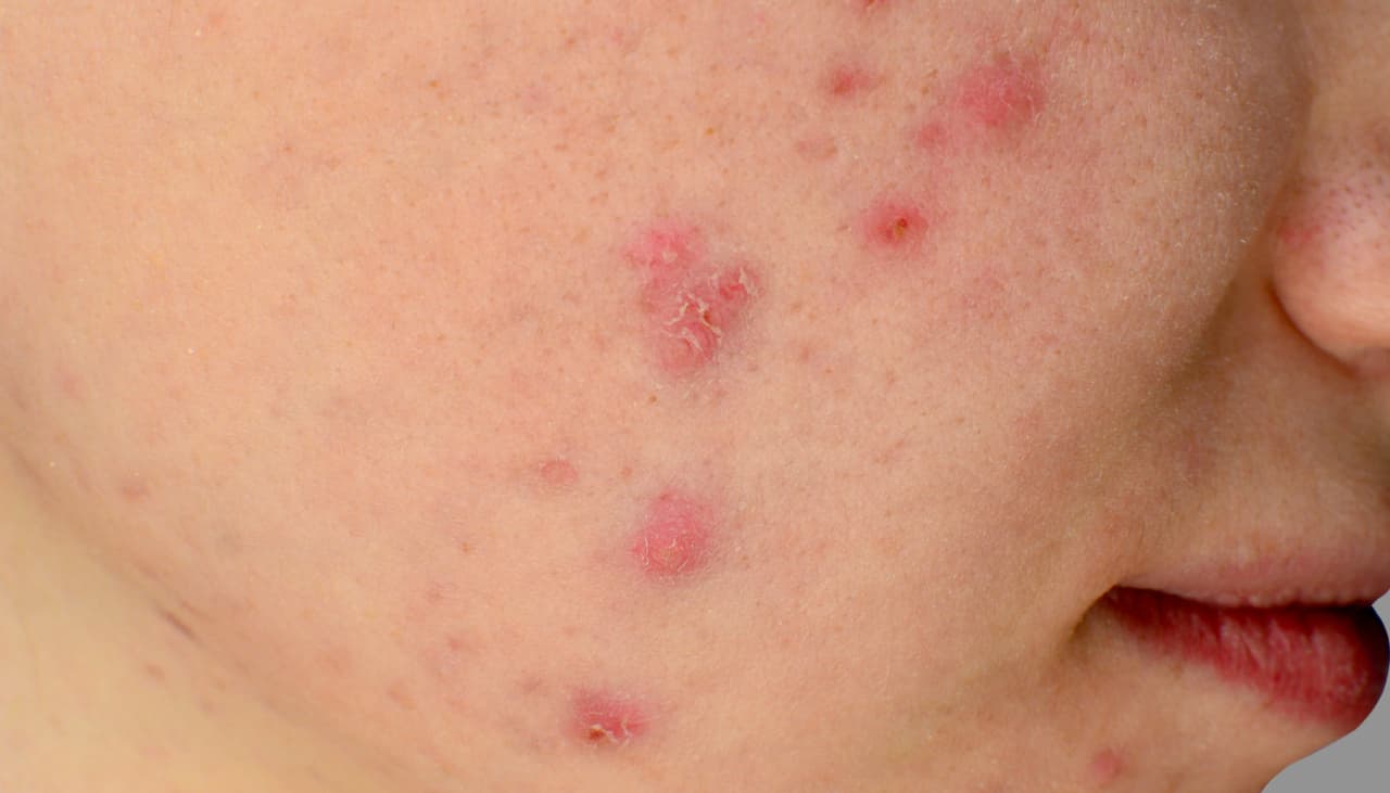 Tu piel puede estar sufriendo los efectos del estrés y estas 11 señales lo revelan