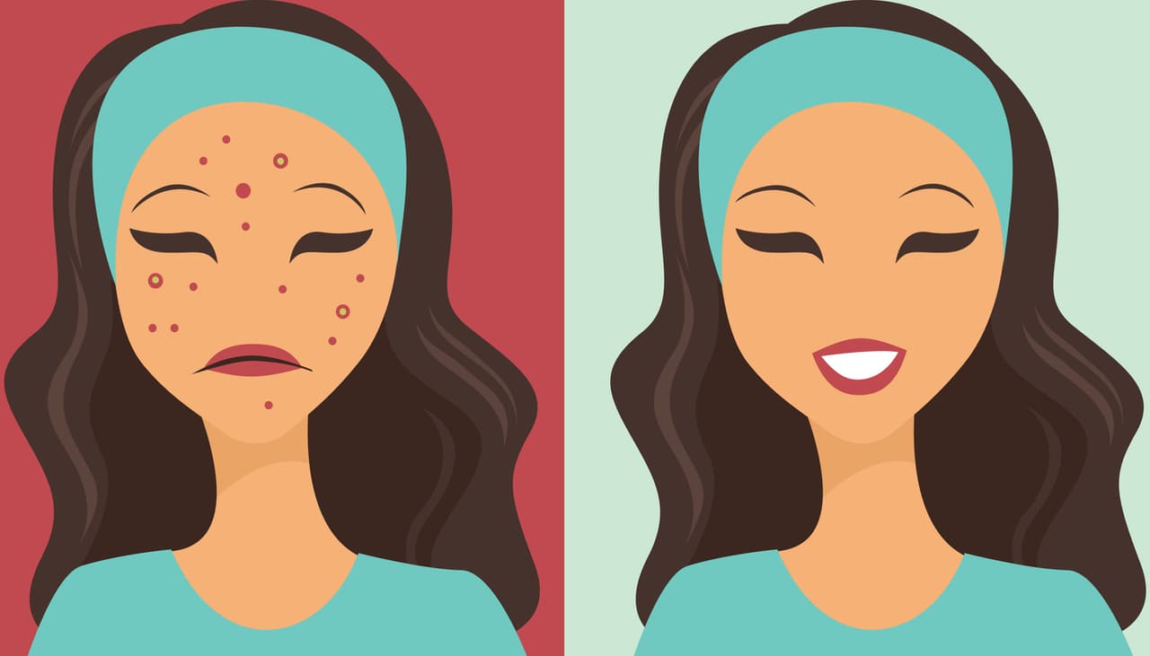 Kit con 4 productos que quienes tienen acné inflamatorio deben tener. Médica recomienda marcas