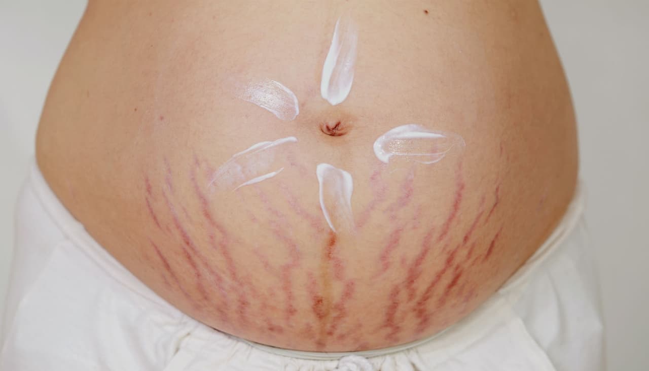 Dermatóloga enseña simple paso a paso para evitar las estrías y el acné en el embarazo