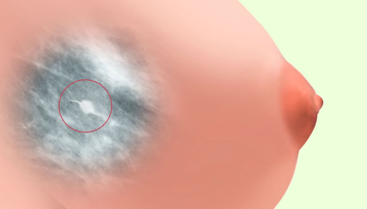 Nueva mamografía que no aprieta los senos ni emite radiación está en fase de pruebas