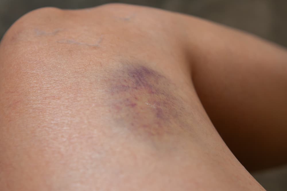 ¿Te aparecen moretones con frecuencia? Pueden ser síntoma de una de 7 enfermedades