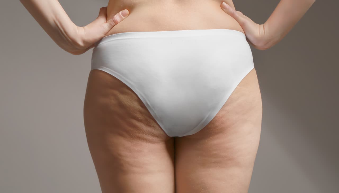 Tus pantalones ajustados pueden causarte celulitis: 4 razones para darles un respiro a tus piernas