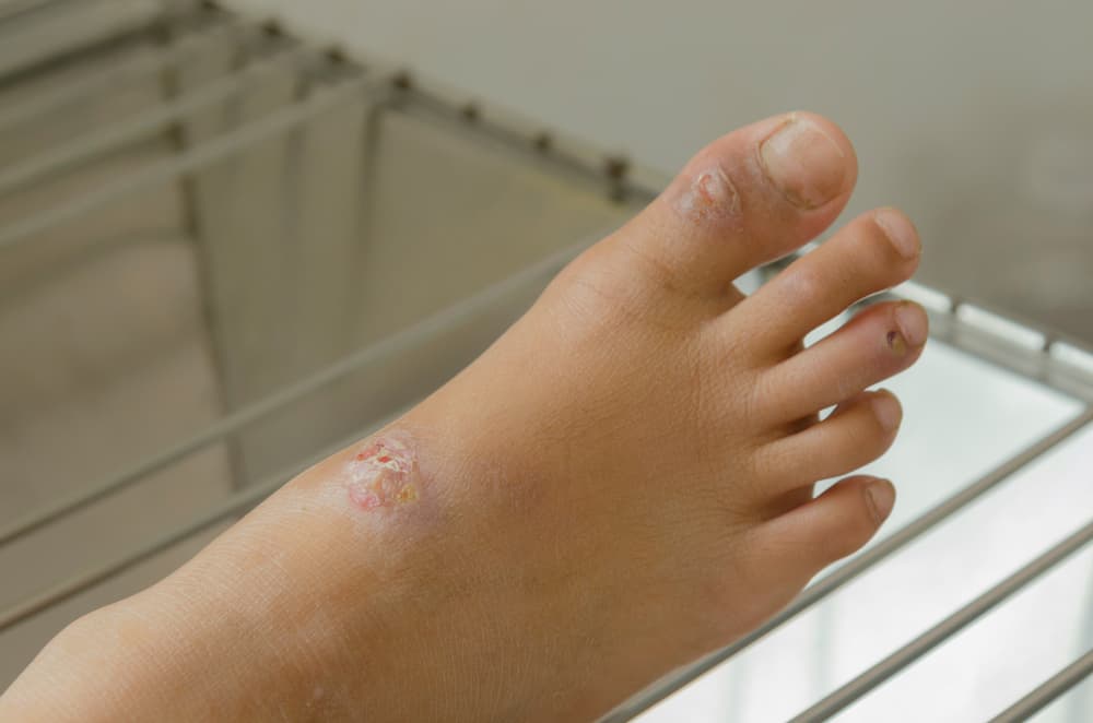 ¿Qué es la celulitis infecciosa y cómo saber si la tienes?