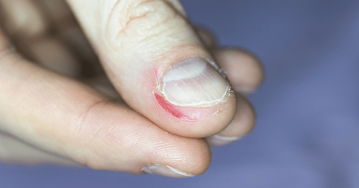 Comerte las uñas puede poner en riesgo tu vida: los peligros de la onicofagia