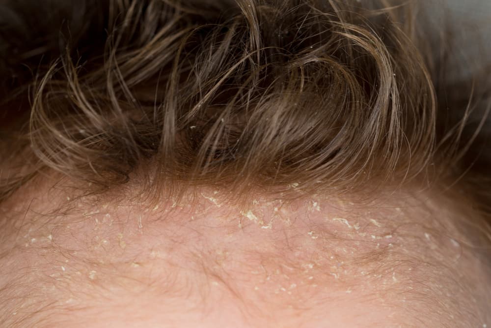 ¿Qué son las manchitas blancas en la cabeza de los bebés? No lo vas a creer