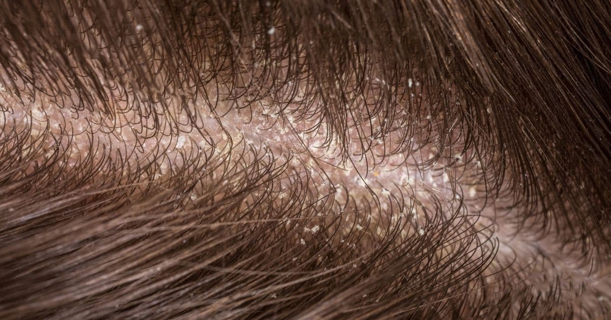 Razones por las que sientes picazón en el cuero cabelludo y no son piojos