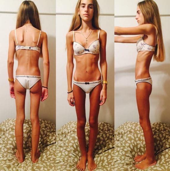 Tuvo anorexia a los 13 y su relato se volvió viral: «Mi cuerpo me pedía a gritos que pare»
