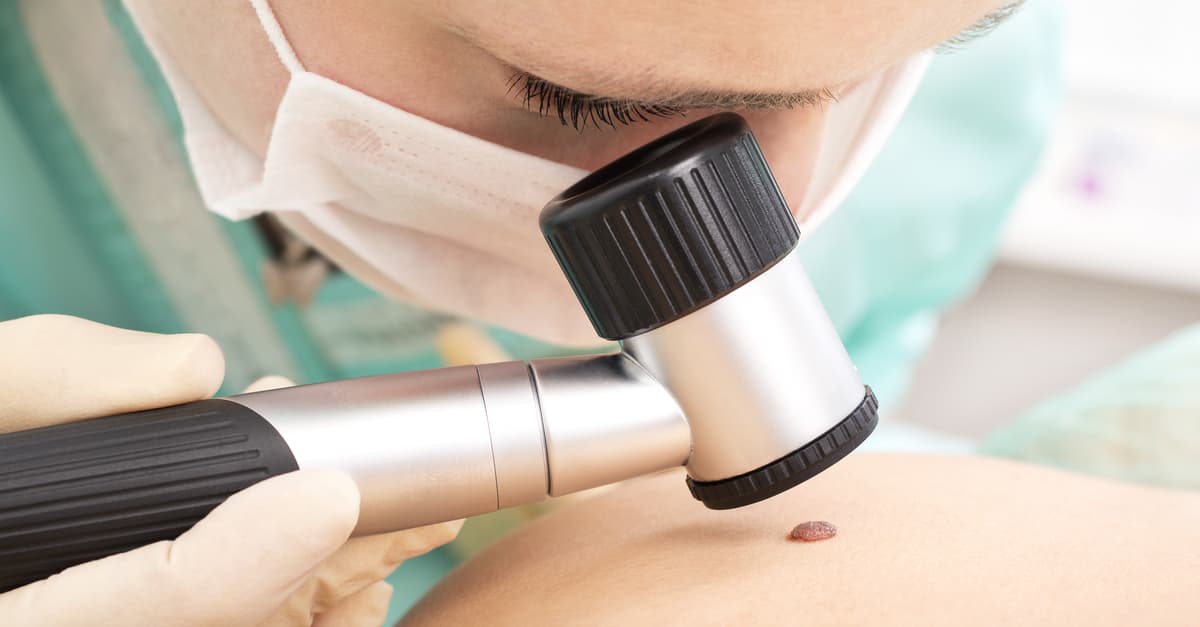 Lunares de sangre: qué son, por qué aparecen y cuándo actuar