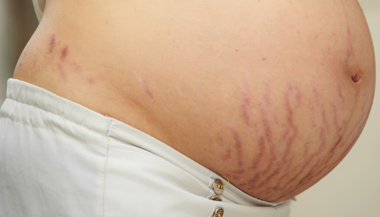 Receta natural para prevenir las estrías en el embarazo: Dermatóloga enseña cómo prepararla