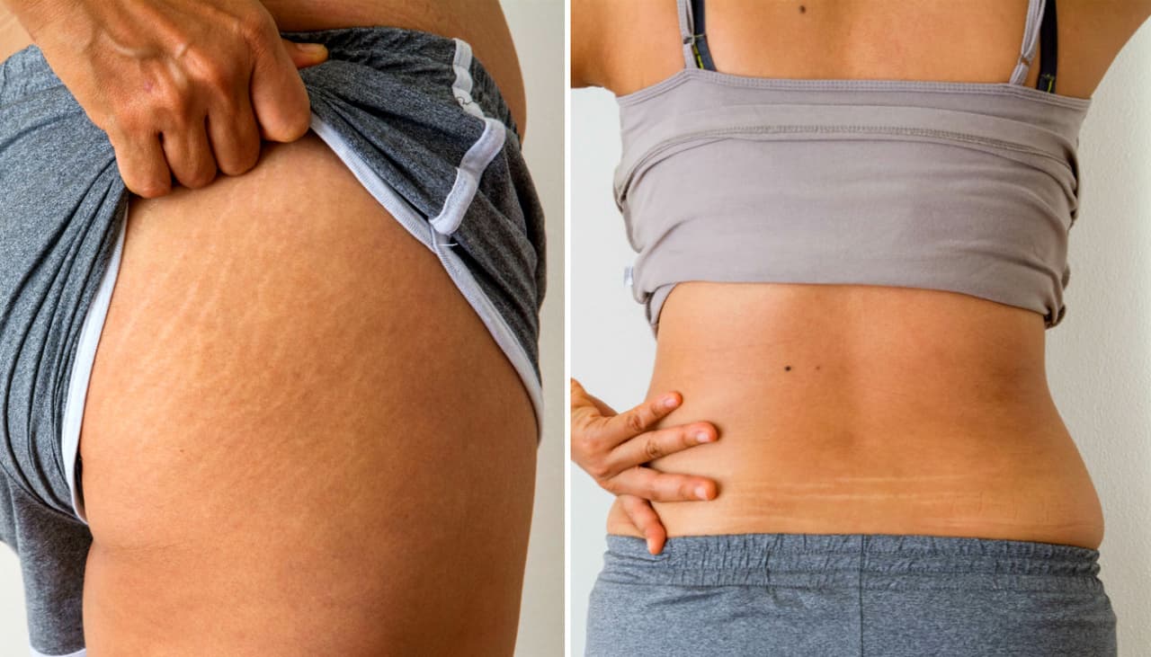 Desvanece las estrías con exfoliantes y mascarillas naturales: 4 recetas para cuidar tu piel