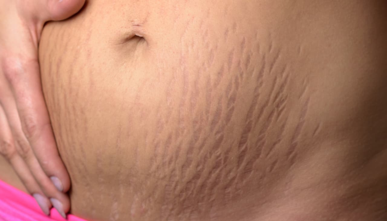 6 lugares del cuerpo donde suelen aparecer estrías (y cómo tratarlas)