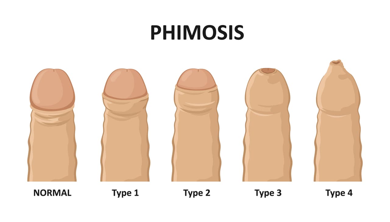 ¿Tu hijo tiene problemas para hacer pipí? Podría tratarse de fimosis