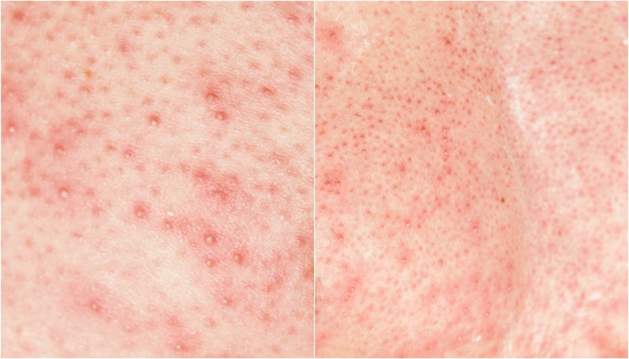 ¿Qué son los puntos rojos que aparecen en brazos, muslos y glúteos?