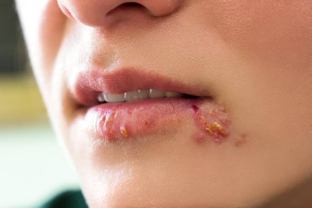 El herpes labial puede querer decir una de estas 8 cosas sobre tu salud