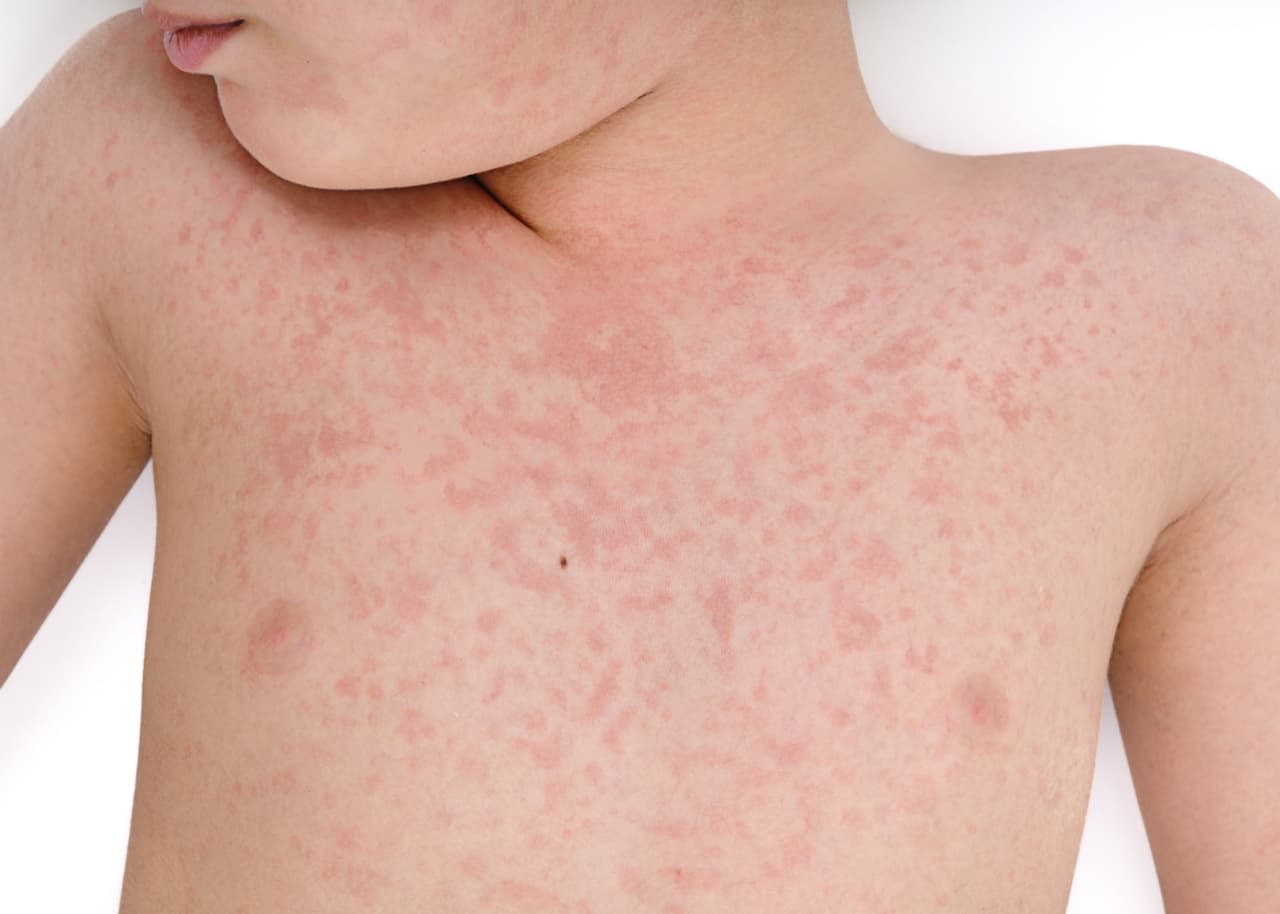 Algunos niños con Covid-19 están desarrollando el síndrome de Kawasaki, advierten los médicos