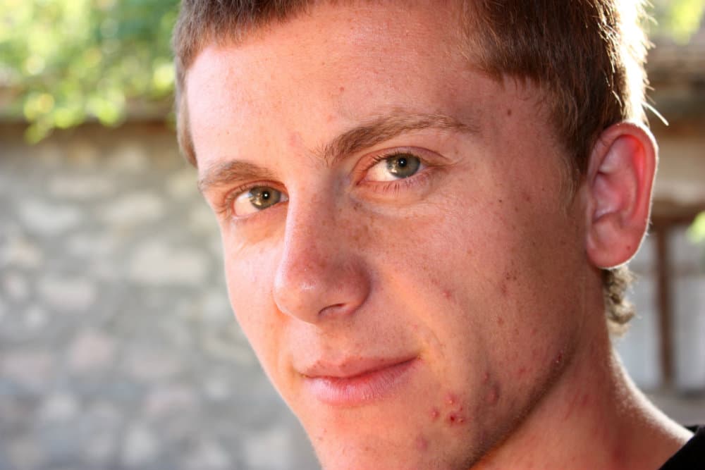 Cómo curar el acné  