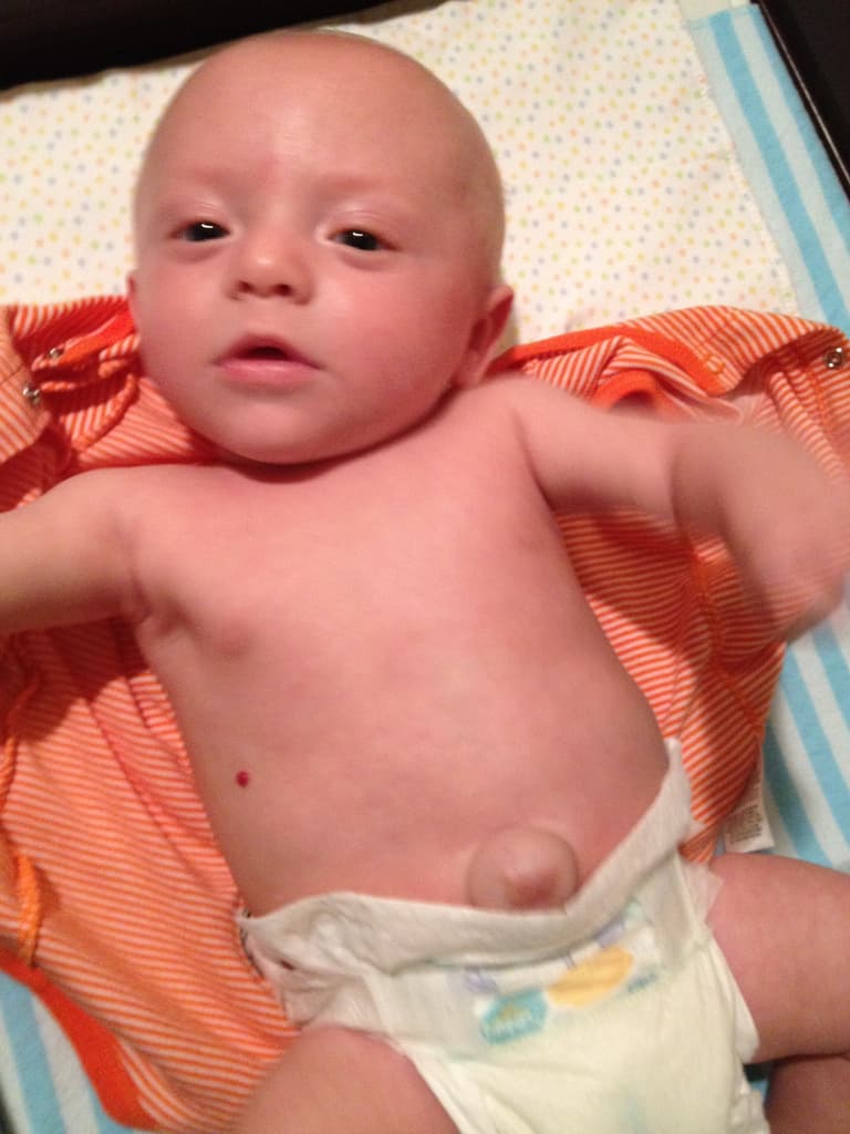 ¿Qué es una hernia umbilical y cómo se trata?