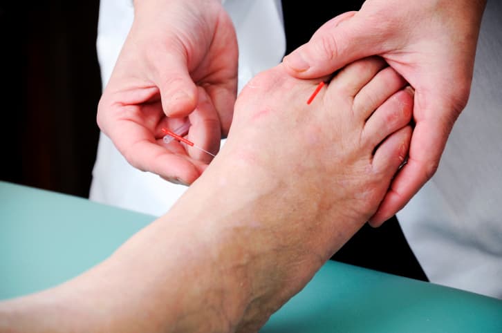 Los tipos de acupuntura que existen