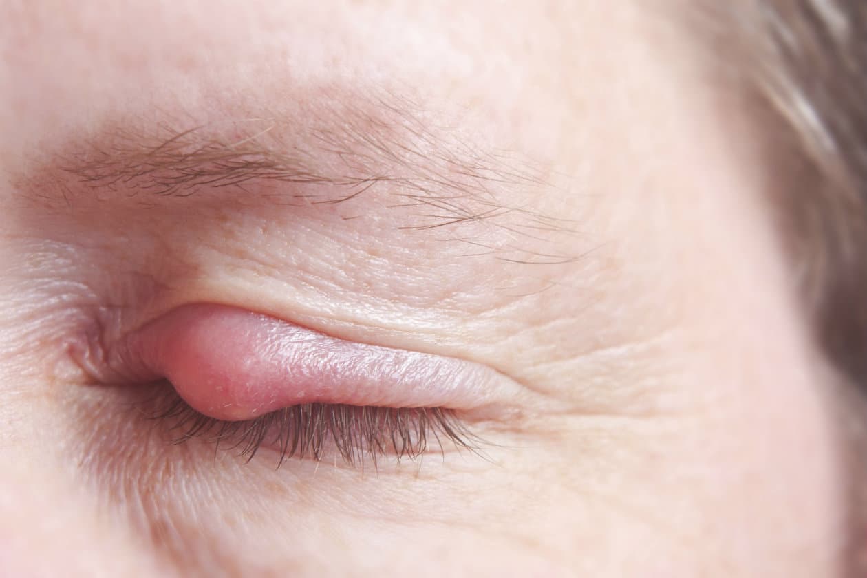 Cómo curar un orzuelo