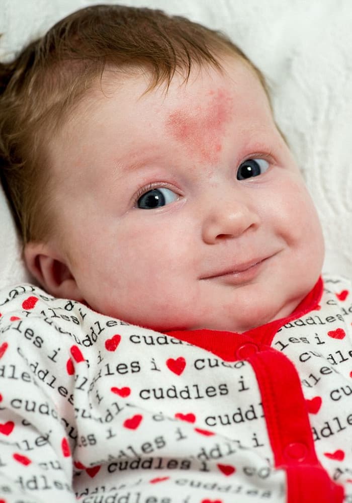 ¿Casualidad? Ella fue concebida en el día de San Valentín y nació con un CORAZÓN en la frente