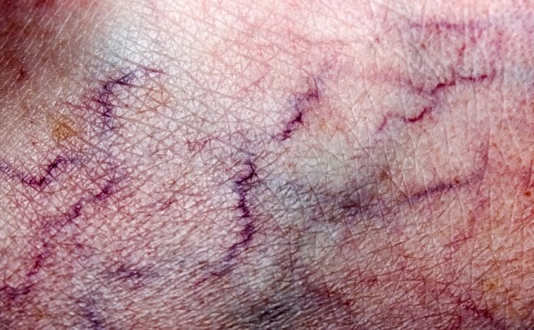 Consejos para prevenir várices