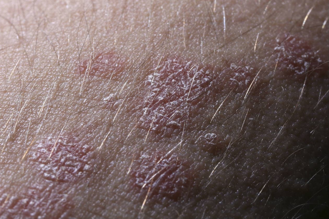 ¿Qué es la dermatitis?