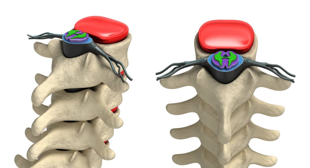 Qué es la mielofibrosis