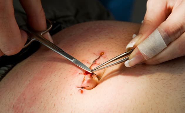 ¿Qué es una hernia?