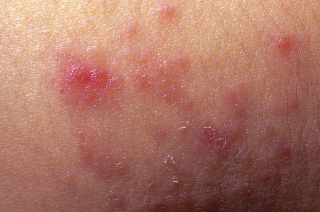 Síntomas de la psoriasis