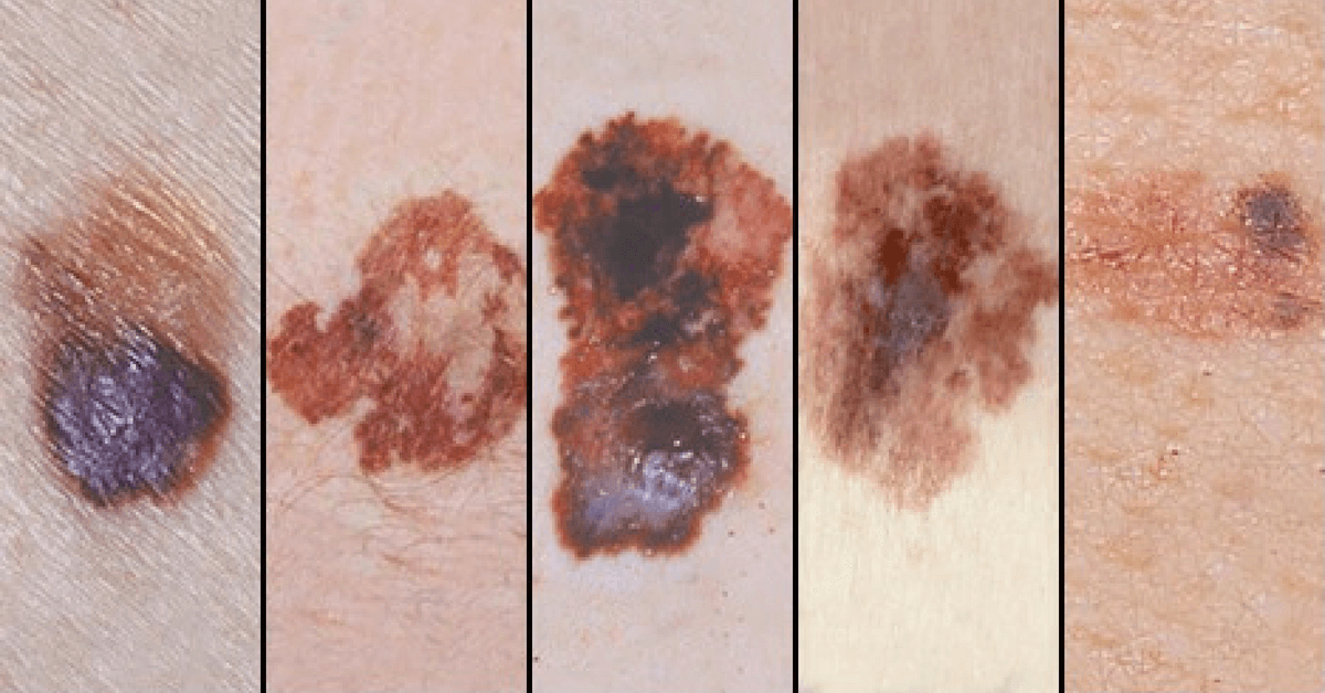 ¿Lunar o melanoma? Con estas fotos puedes descubrir si es cáncer de piel