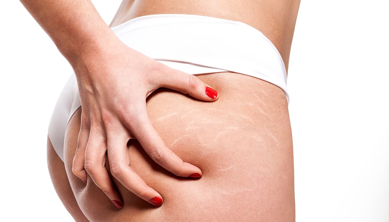 La pomada de la campana puede desvanecer las estrías, pero debes aplicarla correctamente