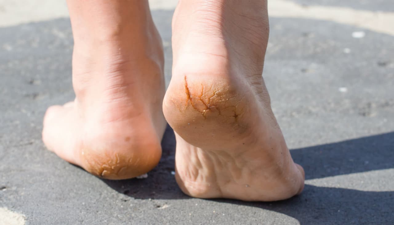 Grietas en los pies: ¿Cómo curarlas? ¿Vinagre, agua oxigenada y bicarbonato funcionan? 