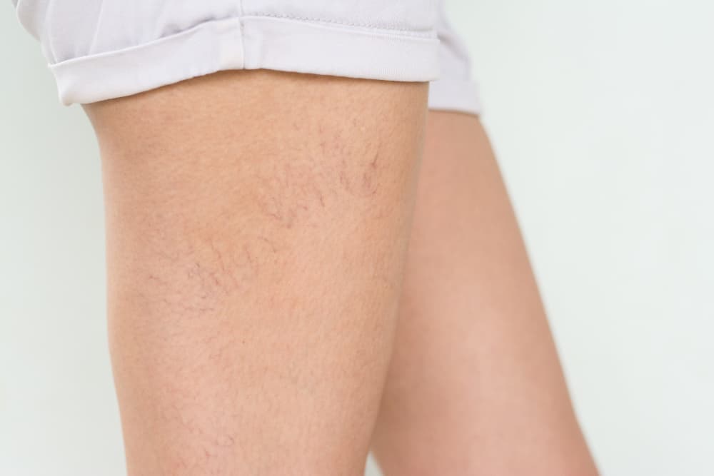 Las arañitas nos pueden aparecer a todas: ¿qué son y cómo tratarlas?