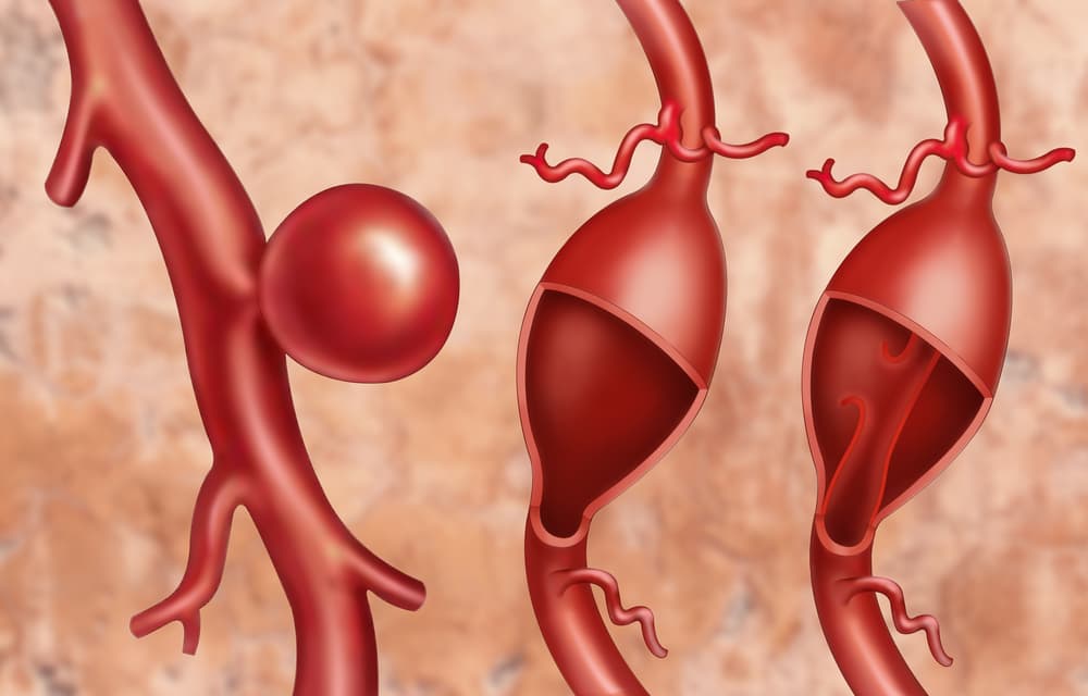 «Cada minuto de cada día pensaba que iba a morir»: ¿qué es un aneurisma? Emilia Clarke tuvo 2