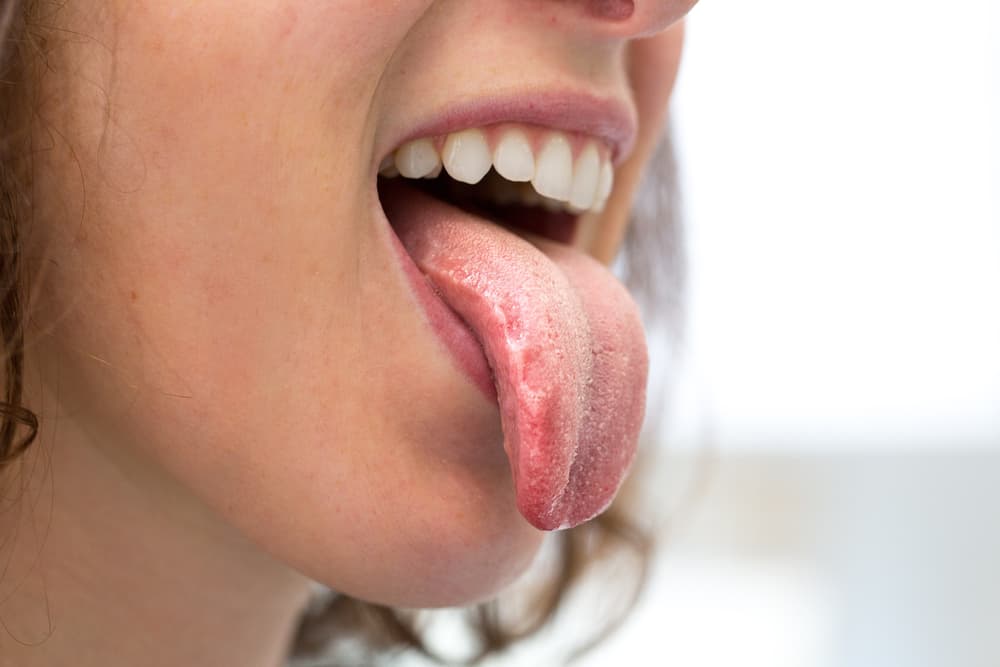 ¿Tu lengua a veces se pone blanca? Esto es lo que dice sobre tu salud