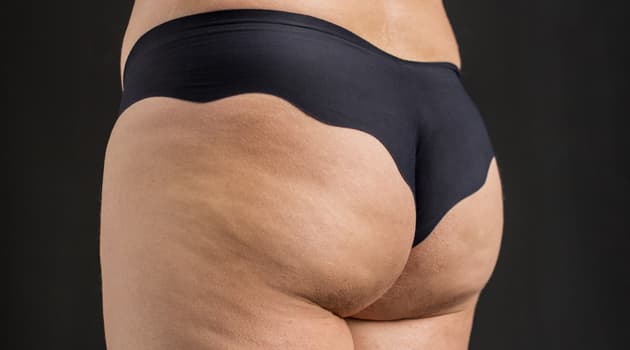 Una dermatóloga elige 2 cremas buenas, bonitas y baratas para acabar con la celulitis