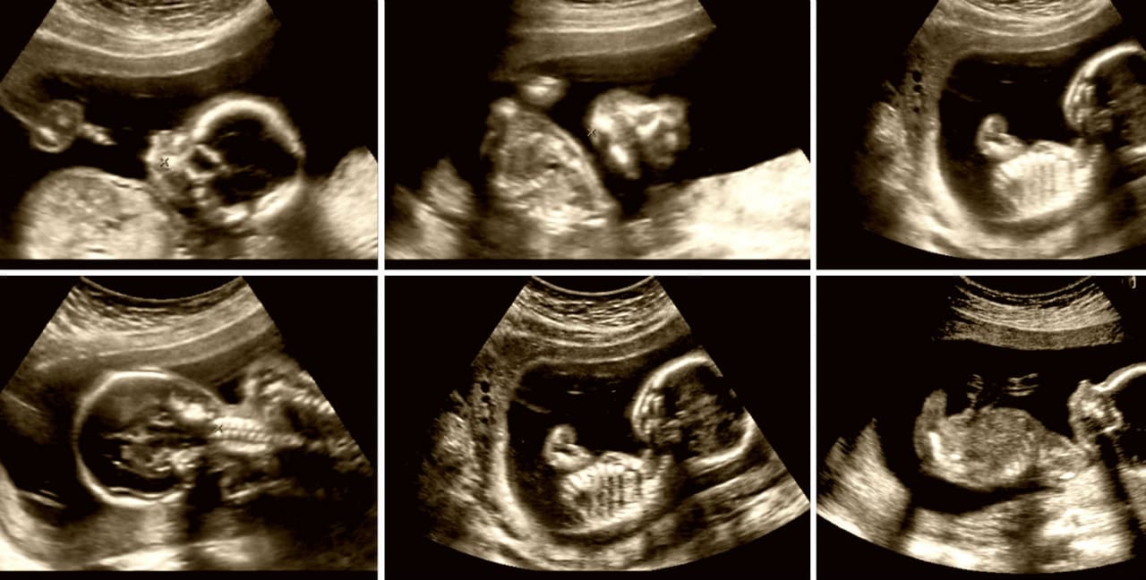 Las patadas de los bebés dentro del vientre tienen hasta 5 kg de fuerza, según estudio