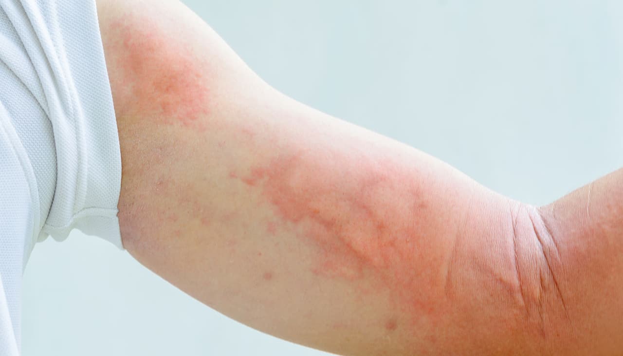 Urticaria: 8 causas comunes y qué hacer