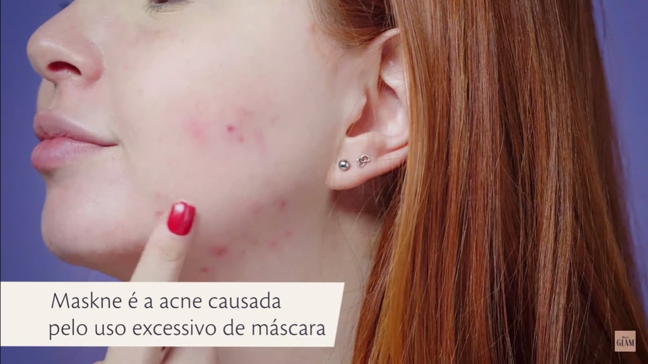 Maskne: como usar a máscara do jeito certo para evitar o aparecimento de espinhas