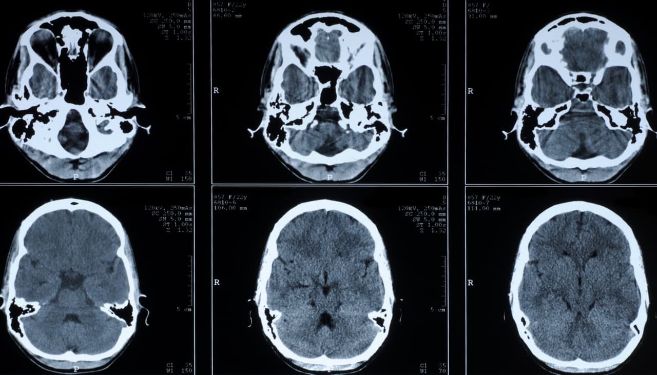El extraño caso de la mujer que sobrevivió 80 años con una aguja en el cerebro que sus padres le enterraron para matarla