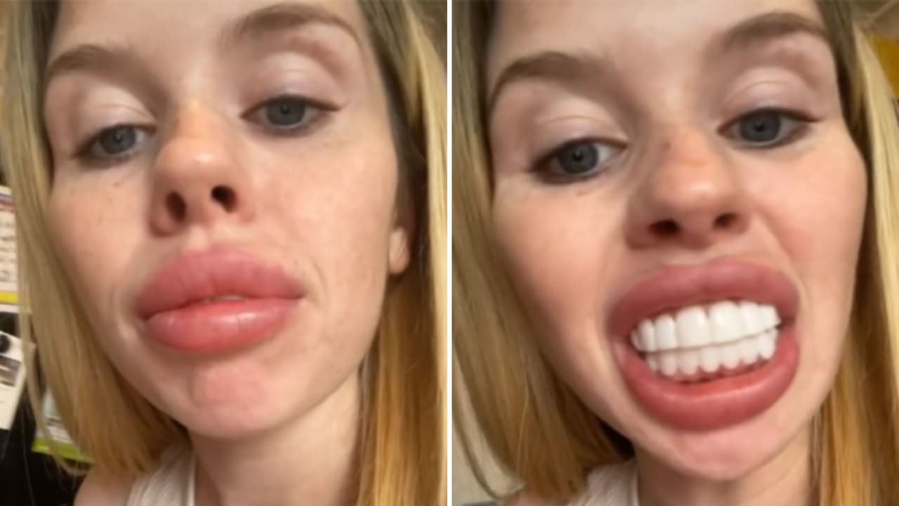 Lauren Hartley muestra cómo se ven sus carillas con clip en TikTok