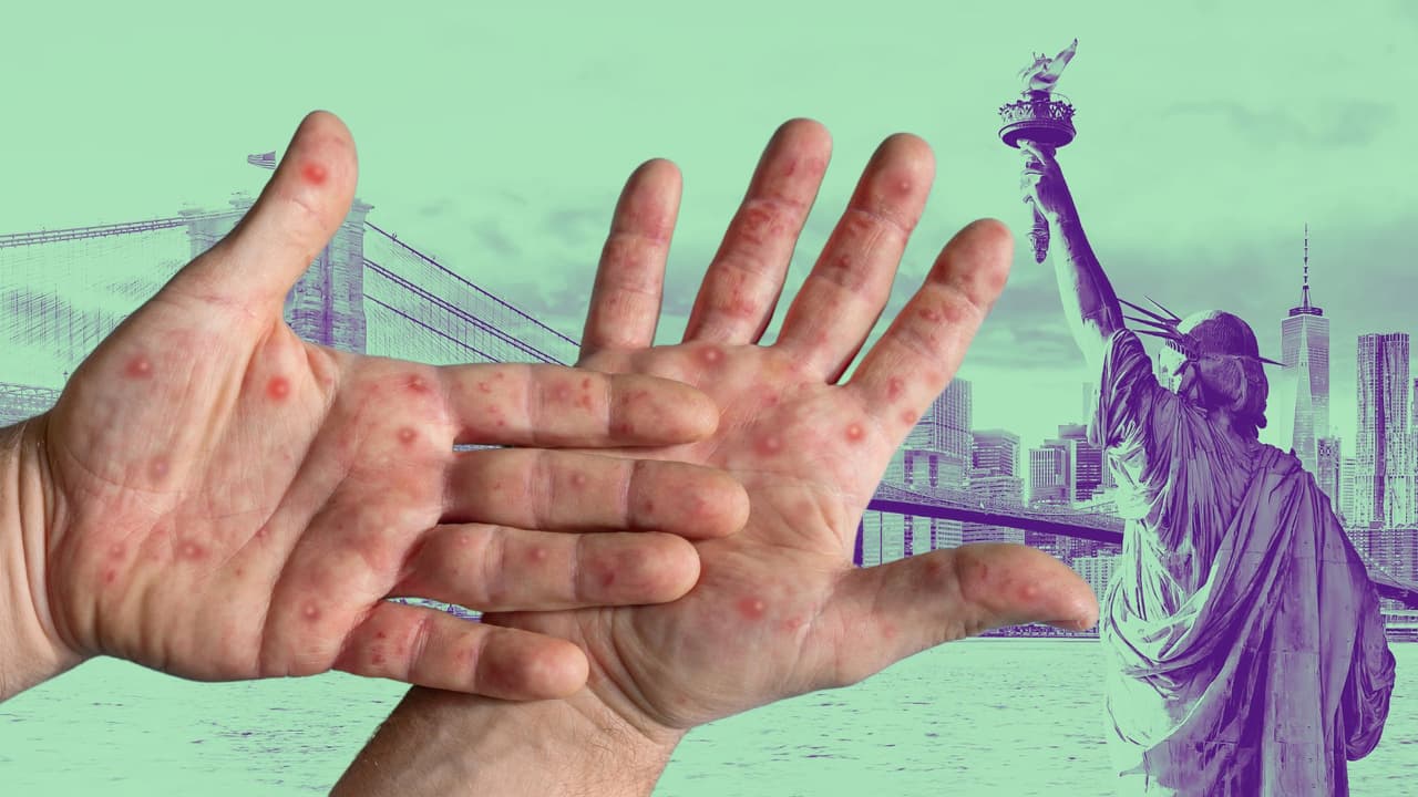 Nueva York detecta primer caso de viruela símica clado I: la variante más severa